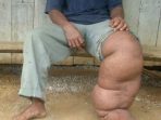 wpid-Penyakit-Kaki-Gajah